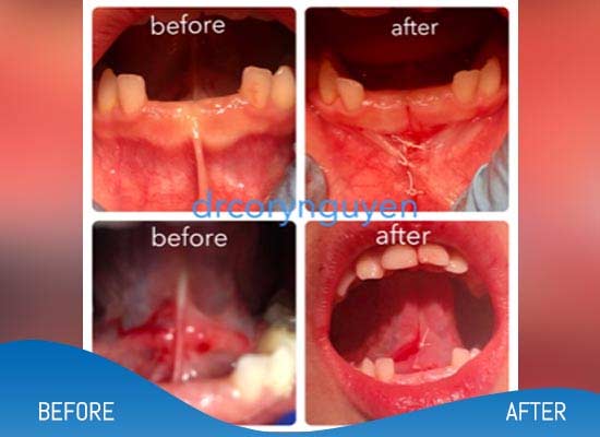 Tongue Tie Surgery Before and After Photos of Patients in Dallas, TX
