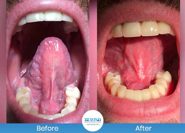 Tongue Tie Surgery Before and After Photos of Patients in Dallas, TX