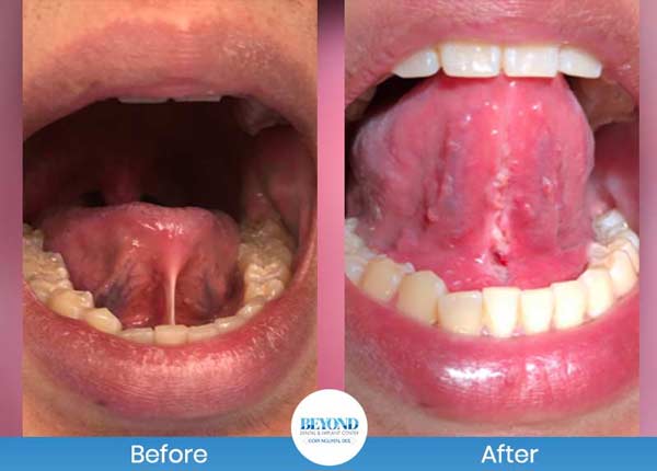 Tongue Tie Surgery Before and After Photos of Patients in Dallas, TX