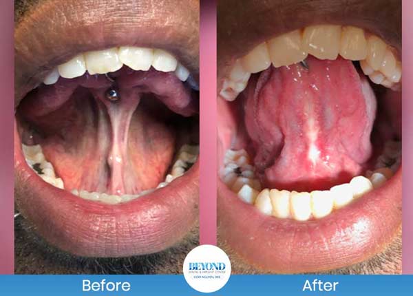 Tongue Tie Surgery Before and After Photos of Patients in Dallas, TX