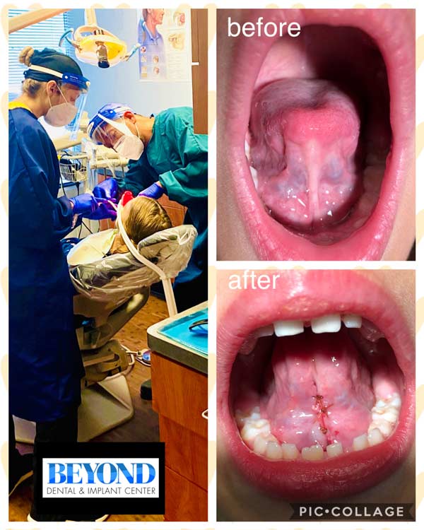 Tongue Tie Surgery Before and After Photos of Patients in Dallas, TX