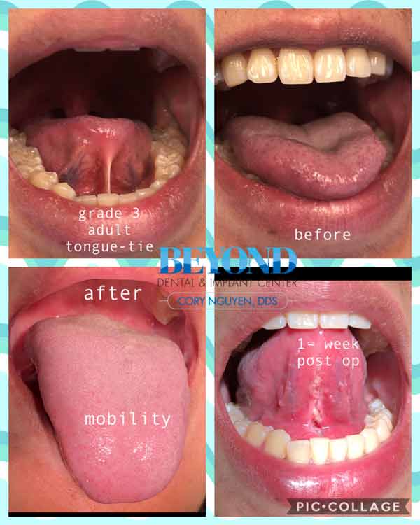 Tongue Tie Surgery Before and After Photos of Patients in Dallas, TX