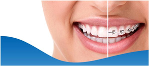 Invisalign vs Braces Near Me in Dallas TX