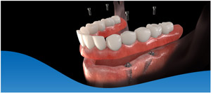 Dental Implants Vs Dentures in Dallas, TX