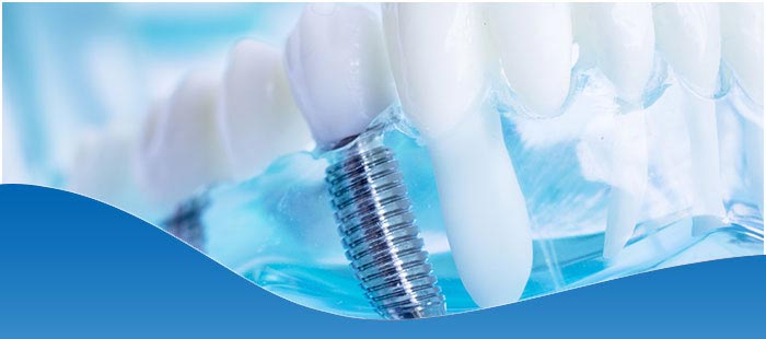 Benefits of Dental Implants in Dallas, TX 