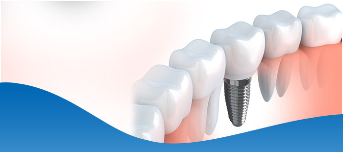 Who Does Dental Implants in Dallas, TX?