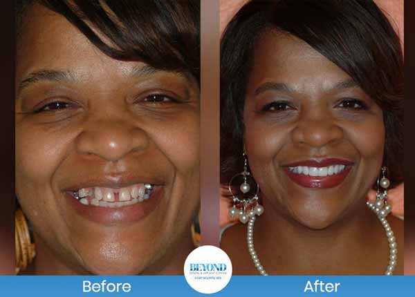 Smile Makeover Gallery in Dallas TX