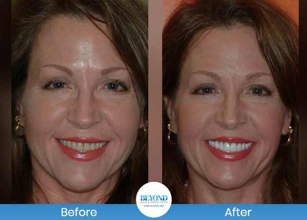 Smile Makeover Gallery in Dallas TX