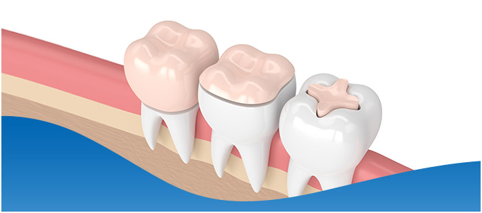 Types of Dental Implants Near Me in Dallas, TX