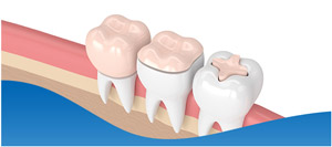 Types of Dental Implants Near Me in Dallas, TX