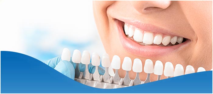 Cost of Dental Whitening Near Me in DFW Area