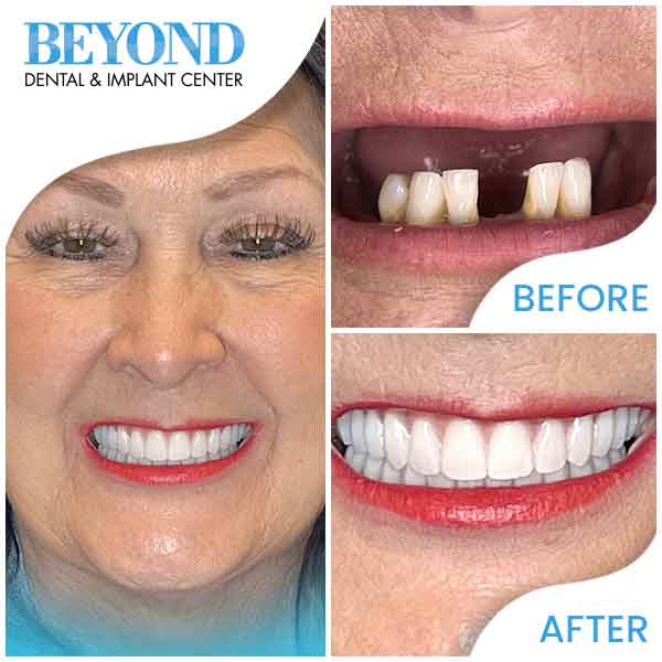 Smile Makeover Before and After Gallery in Dallas, TX