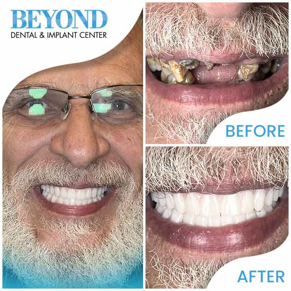 Beyond Dental & Implant Center Real patients, real results and real beautiful new smiles in Dallas, TX (DFW Area)