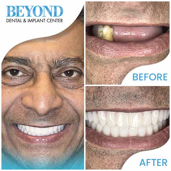 Beyond Dental & Implant Center Real patients, real results and real beautiful new smiles in Dallas, TX (DFW Area)