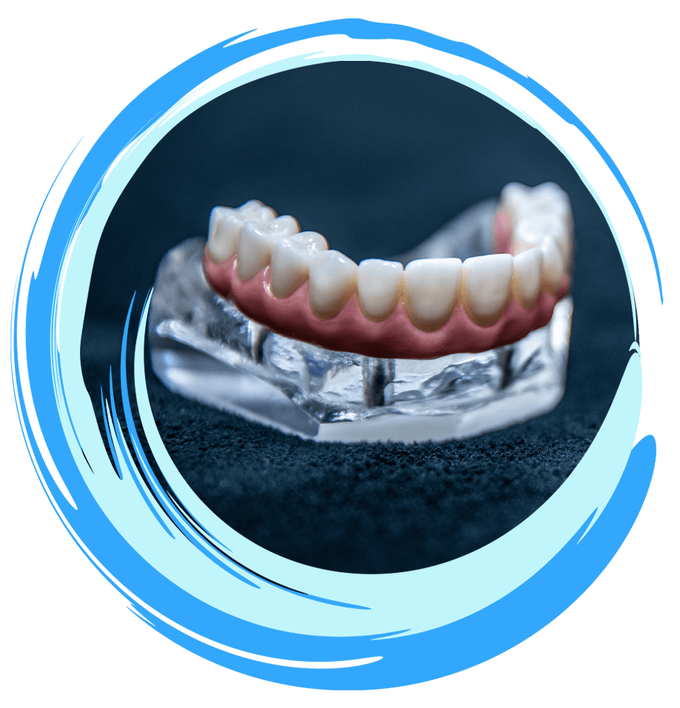 full arch dental implants