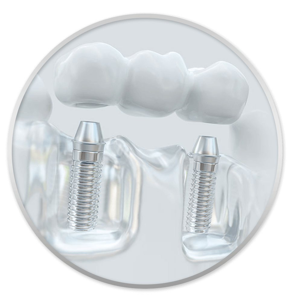 implant bridge