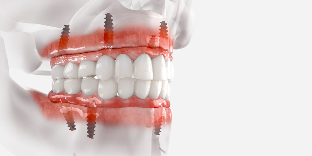 all on 4 dental implants 3d rendering