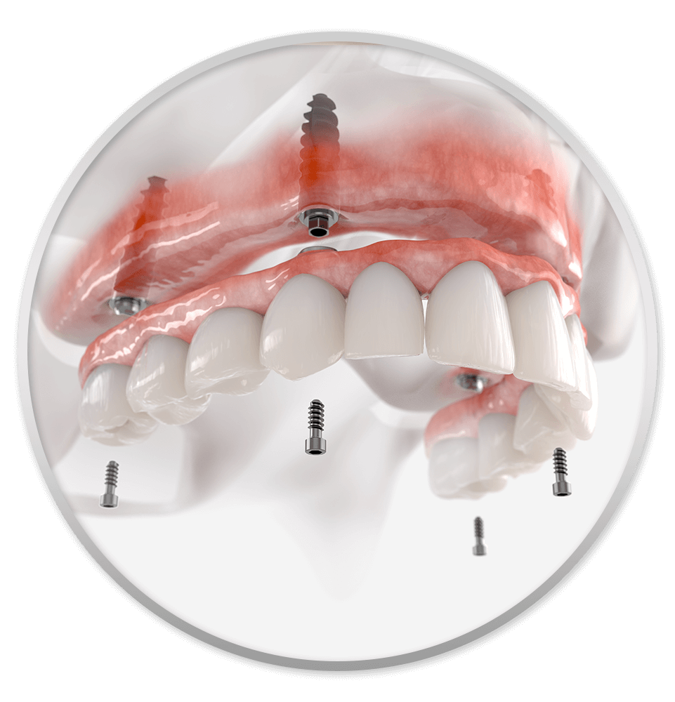 all on 4 full mouth dental implants