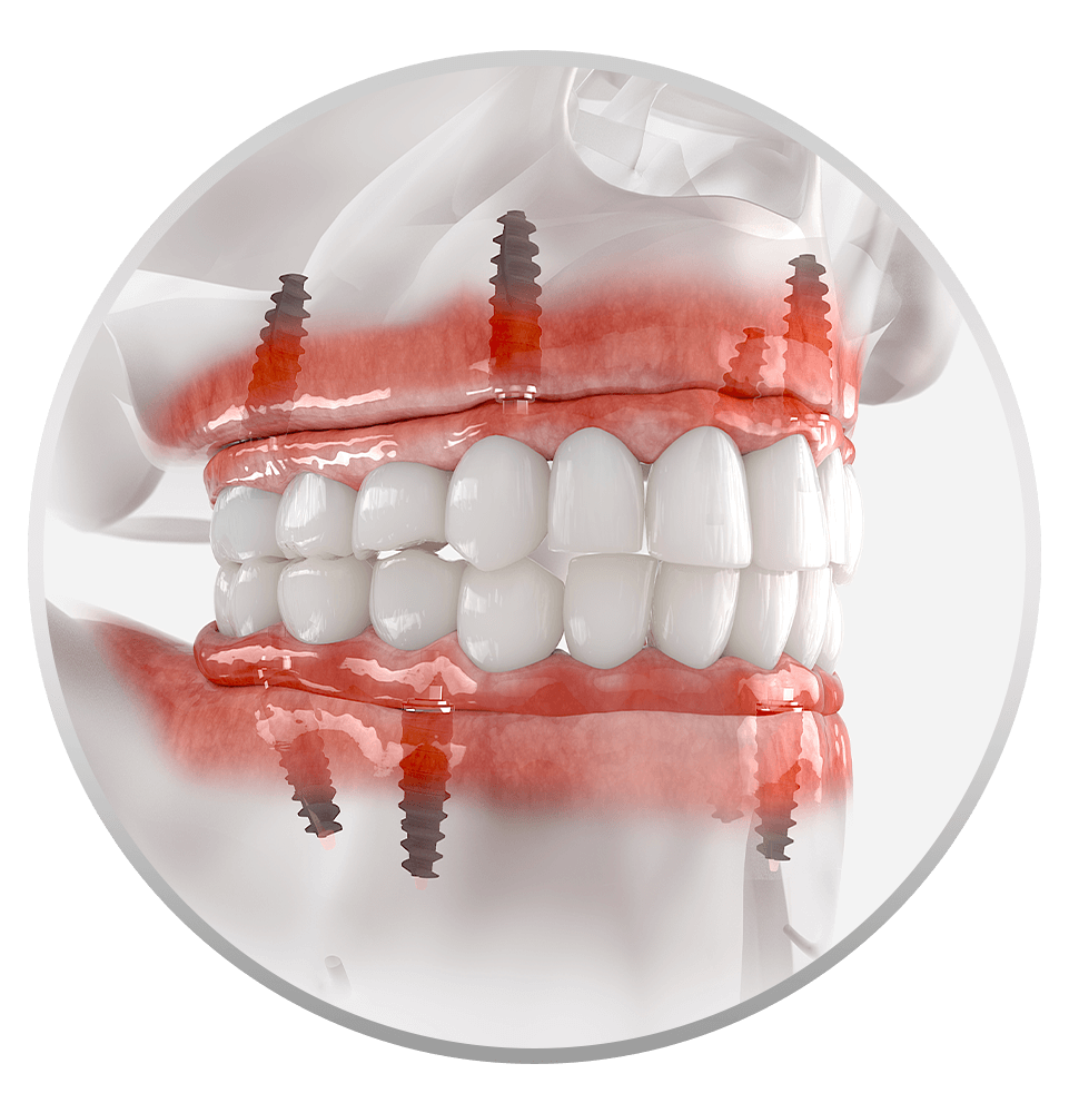 full mouth dental implants