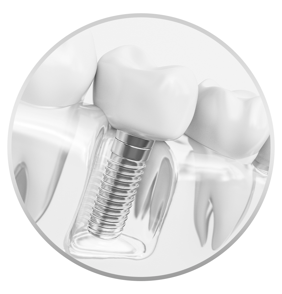 single dental implant