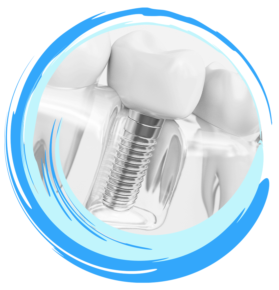single dental implant