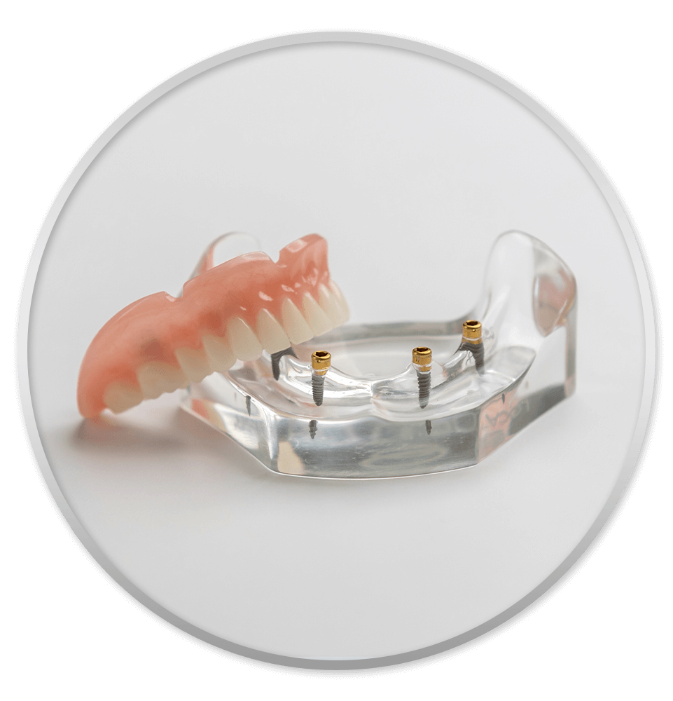 implant supported dentures