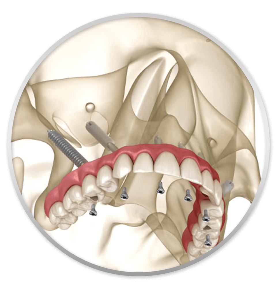pterygoid dental implants
