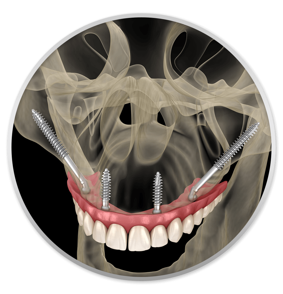 zygomatic dental implants